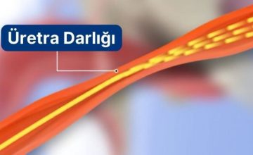 üretre-darlığı (1)